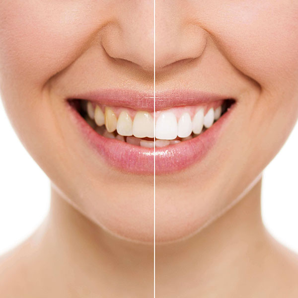Facetas de cerâmica e lentes de contato dental para design de sorriso em São José dos Campos