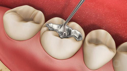 Procedimento de remoção segura de amálgama dentário com protocolo SMART